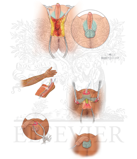 Watermarked preview of unlabeled image: Metoidioplasty, Phalloplasty, And Neoscrotum Formation