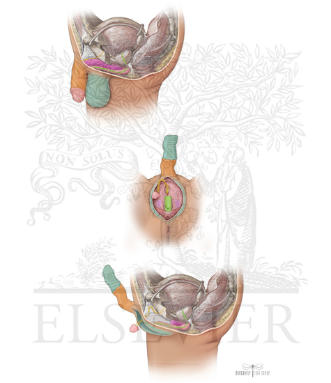 Orchiectomy, Penectomy, And Urethrectomy