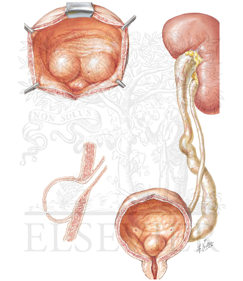 Watermarked preview of unlabeled image: Gross and Fine Appearance of Ureterocele