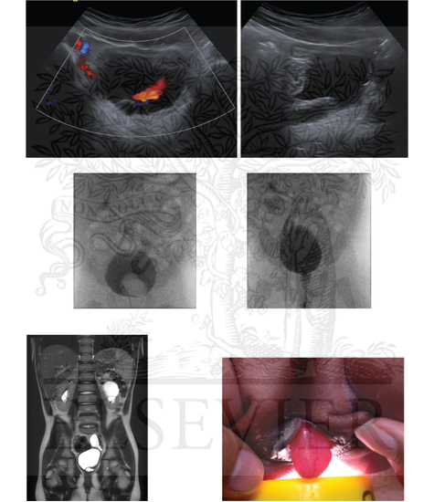 Radiographic Findings of Ureterocele