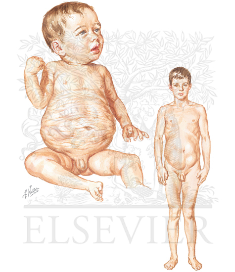 Watermarked preview of unlabeled image: Appearance of Abdominal Wall in Prune Belly Syndrome