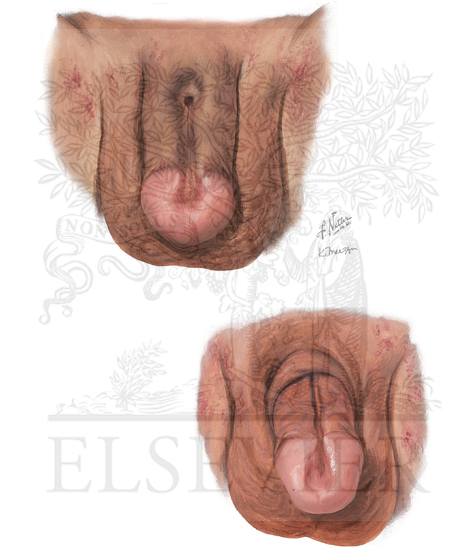 Epispadias 