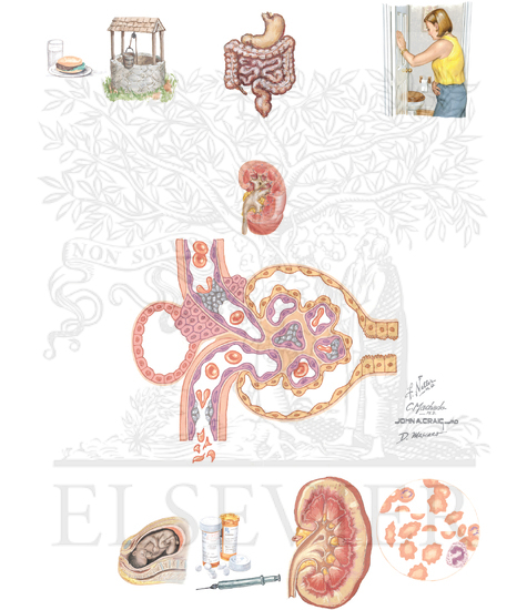 Pathophysiology and Clinical Features of Hemolytic-Uremic Syndrome