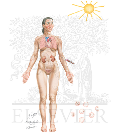 Watermarked preview of unlabeled image: Diagnostic Criteria of Systemic Lupus Erythematosus