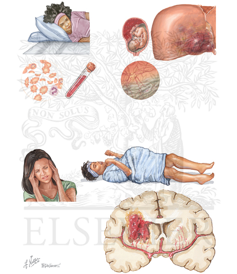 HELLP Syndrome and Eclampsia