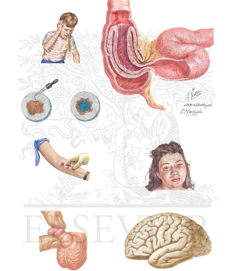 Watermarked preview of unlabeled image: Additional Clinical Manifestations of Henoch Schonlein Purpura 