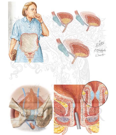 Stress Urinary Incontinence