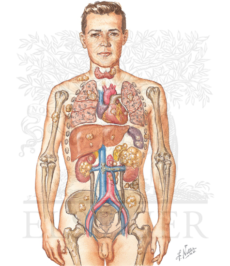 Sites of Metastasis in Renal Cell Carcinoma