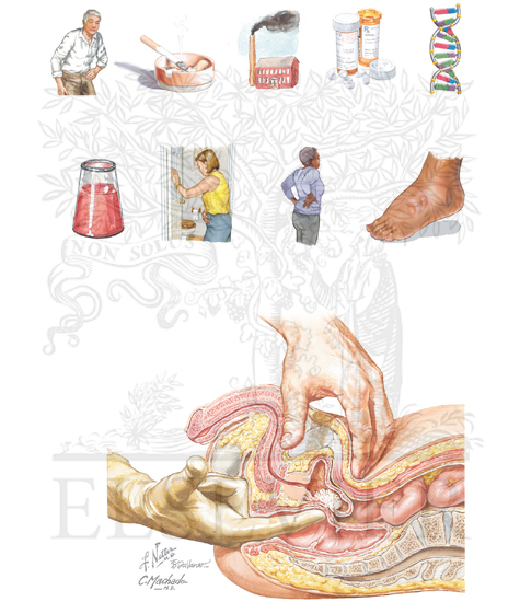 Risk Factors, Symptoms, and Physical Examination of Tumors of the Bladder