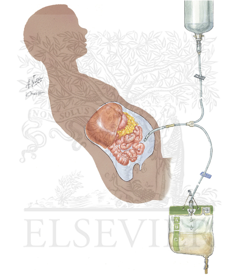 Peritoneal Dialysis