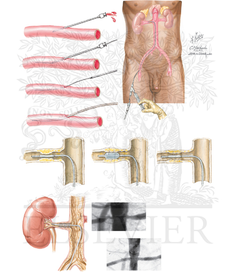 Watermarked preview of unlabeled image: Endovascular Therapies for Renal Artery Stenosis