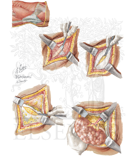 Open Simple Nephrectomy (Flank Approach)