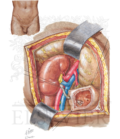 Watermarked preview of unlabeled image: Recipient Operation in Kidney Transplantation