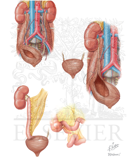 Ureter Reimplantation