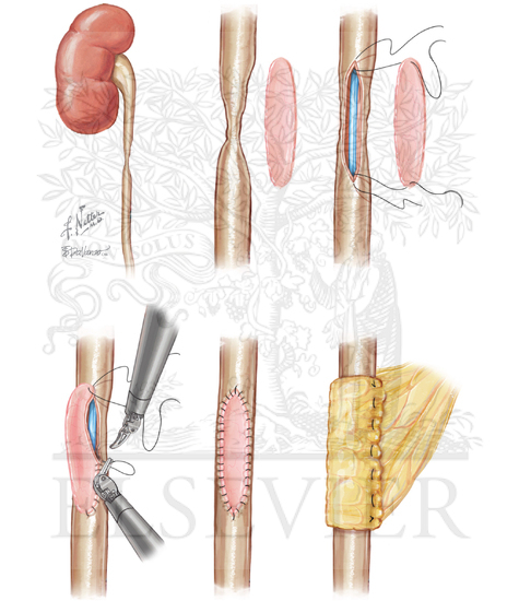 Robotic Buccal Ureteroplasty 