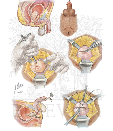 Benign Prostate Surgery: Perineal