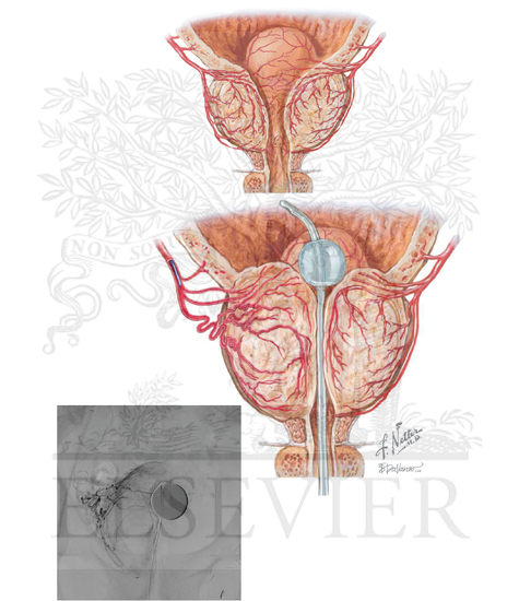 Interventional Prostate Artery Embolization