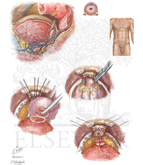 Watermarked preview of unlabeled image: Malignant Prostate Surgery: Retropubic