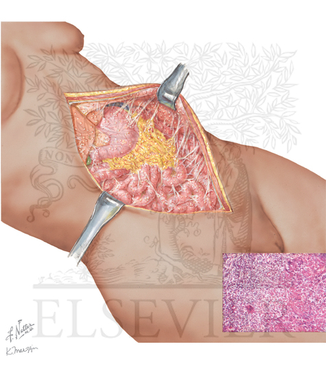 Chronic Peritonitis