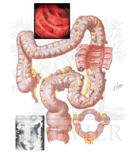 Diverticulosis of Colon