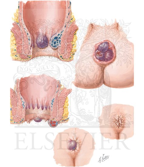 female hemorrhoids pictures real