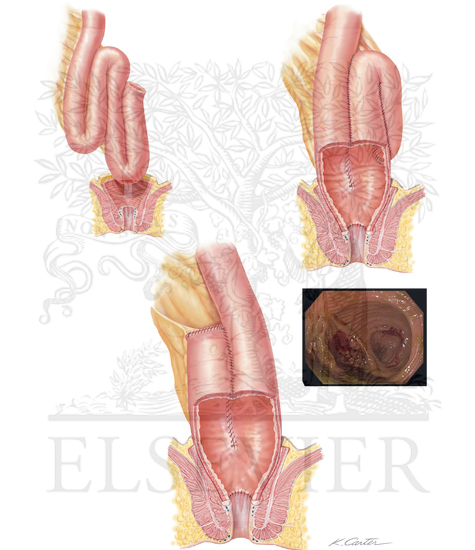Ileal Pouch Anal Anastomosis (IPAA) and Pouchitis