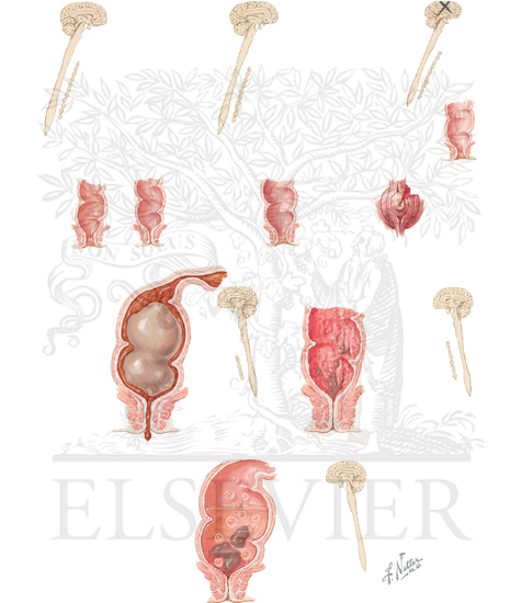 Watermarked preview of unlabeled image: Pathophysiology of Defecation ...