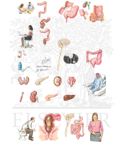 Watermarked preview of unlabeled image: Overview of Constipation