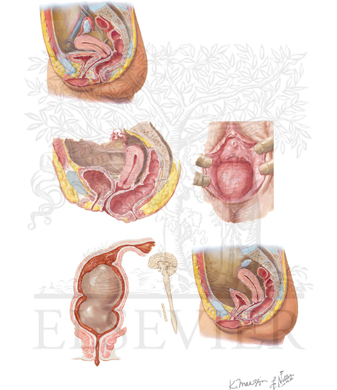 Pelvic Floor Dysfunction and Constipation