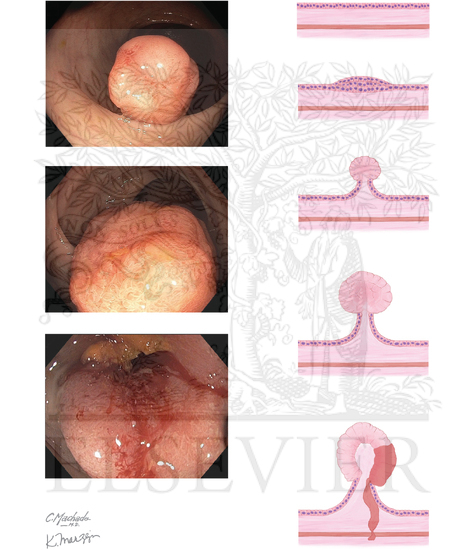 Watermarked preview of unlabeled image: Genetics of Colon Cancer