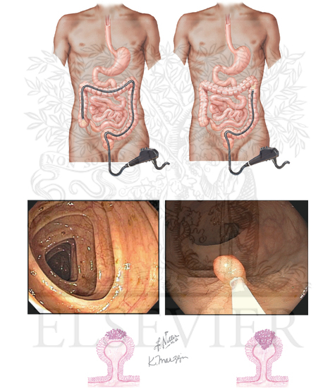 Watermarked preview of unlabeled image: Colon Cancer Screening Guidelines