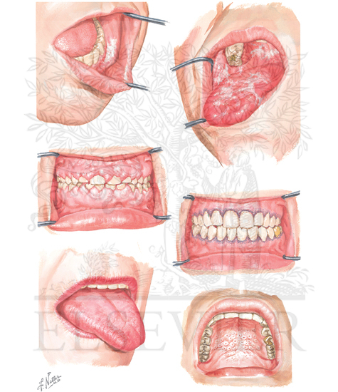 Effects of Iatrogenic Agents on Oral Mucosa