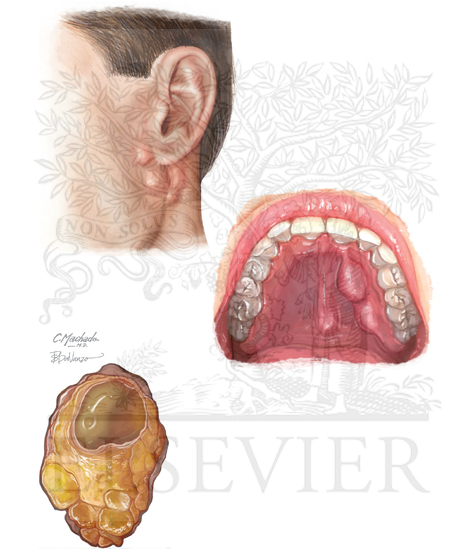 Watermarked preview of unlabeled image: Malignant Tumors of Salivary Glands