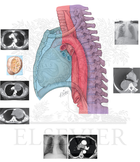 Esophageal Duplication Cysts