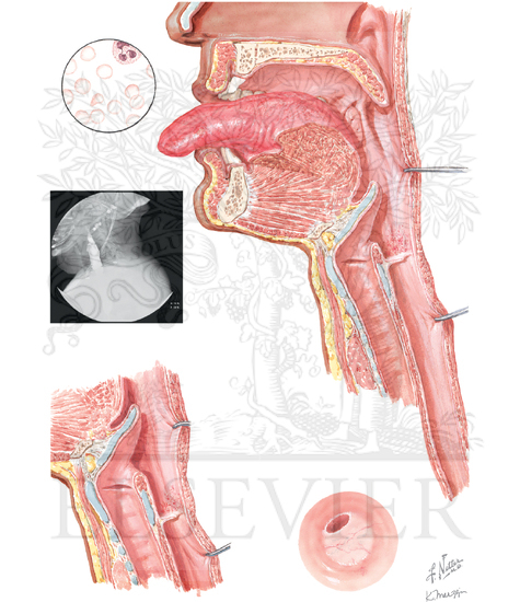 Plummer-Vinson Syndrome