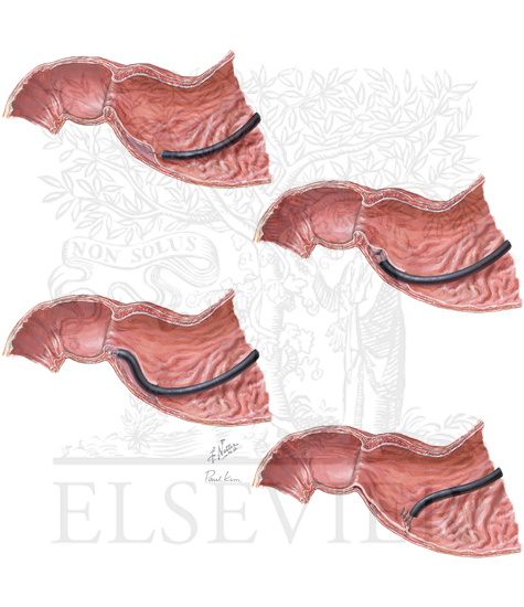 Watermarked preview of unlabeled image: Endoscopic Pyloromyotomy for Gastroparesis