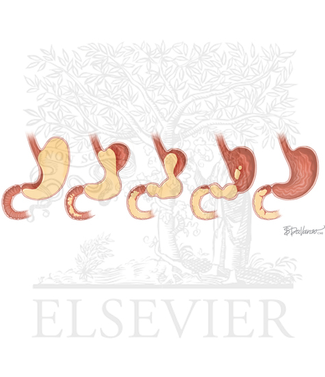 Watermarked preview of unlabeled image: Diagnostic Tests in Gastric Disorders: Gastric Emptying Scintigraphy