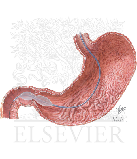 Watermarked preview of unlabeled image: Diagnostic Tests in Gastric Disorders: EndoFLIP of the Pylorus