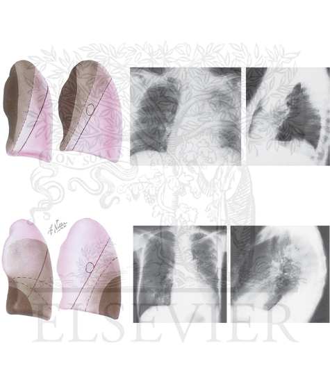 Patterns of Lobar Collapse: Left Lung (After Lubert and Krause)