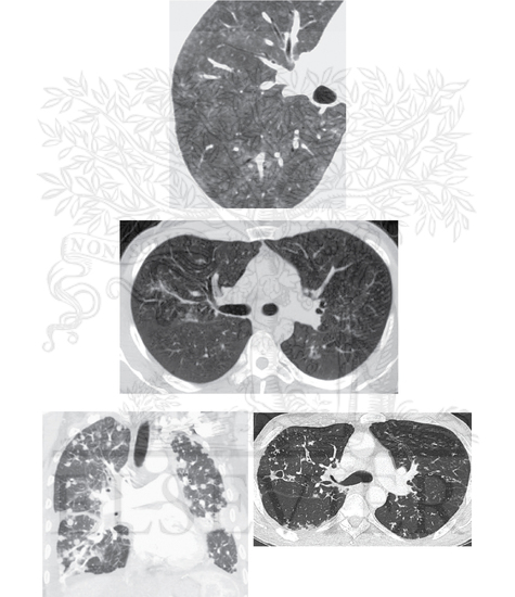 Distribution of Pulmonary Nodules