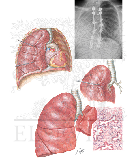 Pulmonary Agenesis, Aplasia, and Hypoplasia