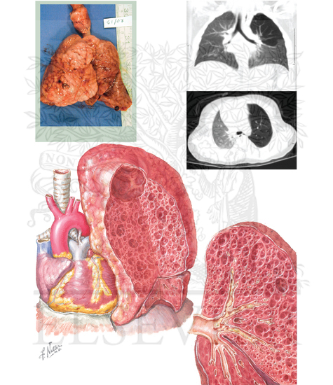 Congenital Lobar Overdistension