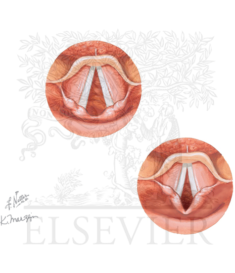 Vocal Cord Dysfunction