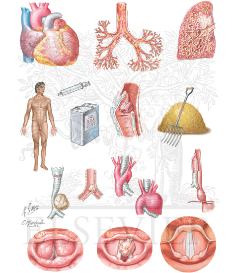 Representative Differential Diagnosis of Bronchial Asthma