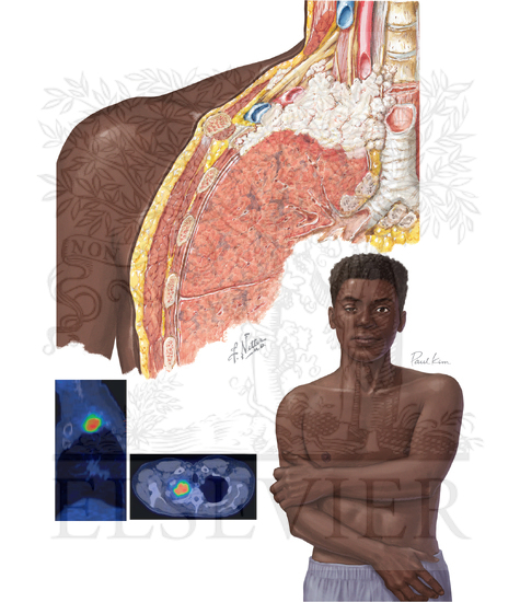 Pancoast Tumor and Syndrome