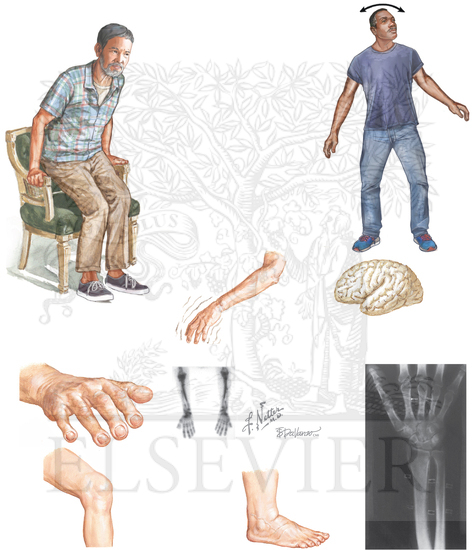 Watermarked preview of unlabeled image: Neuromuscular and Connective Tissue Manifestations