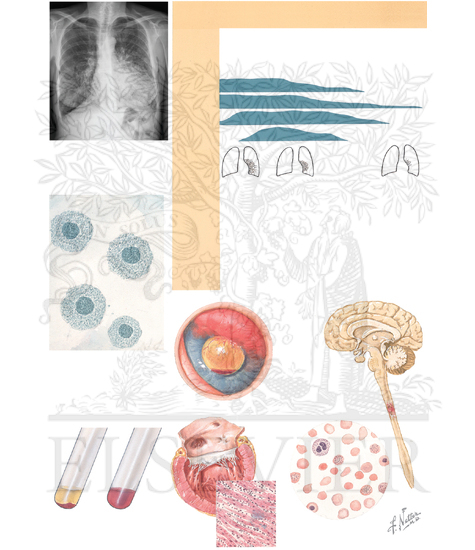 Mycoplasma Pneumonia