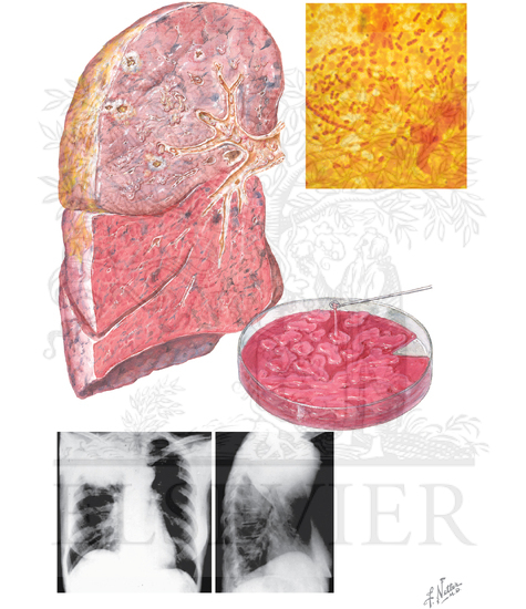 Watermarked preview of unlabeled image: Gram-Negative Bacterial Pneumonia