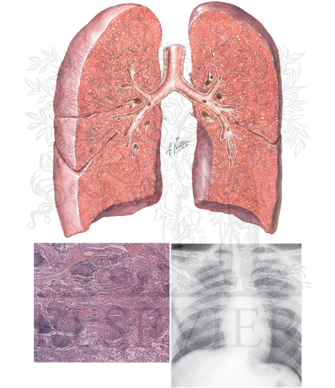 Miliary Tuberculosis