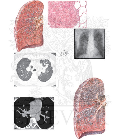 Silicosis